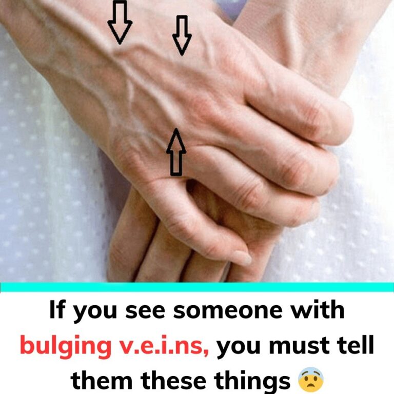 Someone_with_bulging_v_e_i_ns